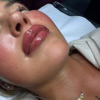 Glossy lip treatment result